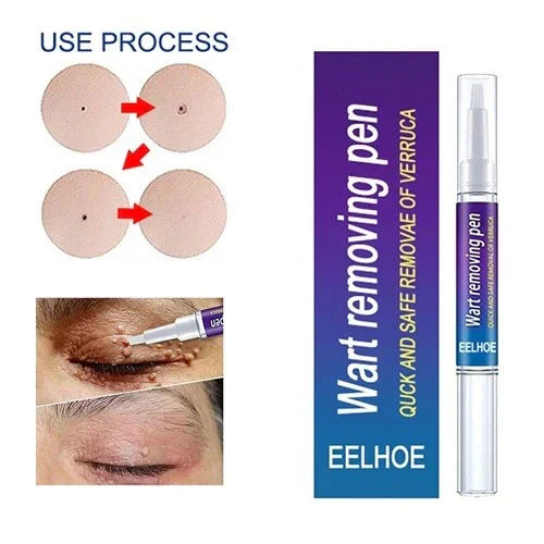 Warts & Moles Remover Pen