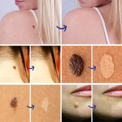 Warts & Moles Remover Pen